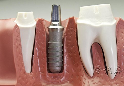 种植牙可以报销医保吗