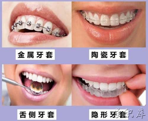 牙套价格一般是多少钱一个，附影响牙套价格因素