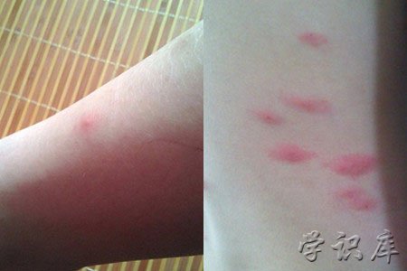 螨虫叮咬后的症状图