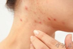 螨虫叮咬后的症状图，被螨虫咬的症状图片