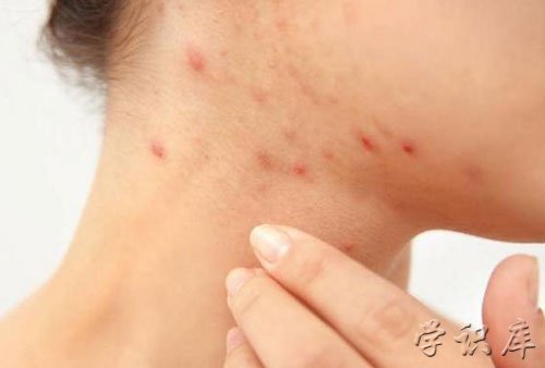 螨虫叮咬后的症状图