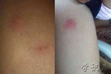 被螨虫咬的症状图片