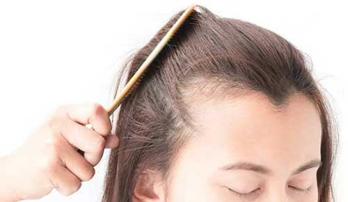 发际线太高了怎么挽救(6种方法拯救你的发际线)