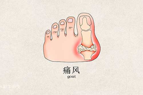 痛风怎么治疗最有效的方
