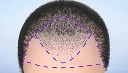 植发5000个毛囊多少钱，植发的费用范围