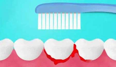 牙龈出血要警惕三种病