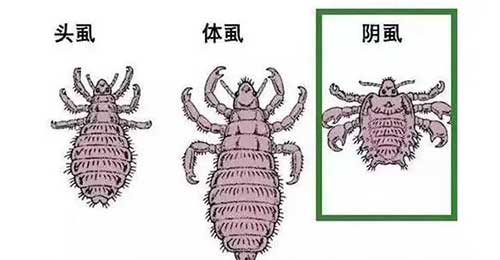 阴虱怎么彻底去除最简单的方法，去除阴虱的5个措施