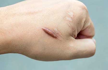 疤痕增生凸起来一块肉怎么办